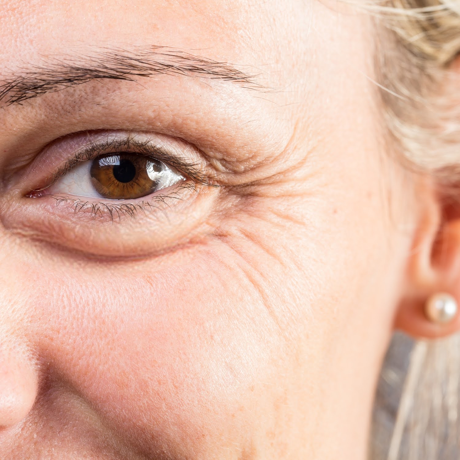 How to Get Rid of Crow's Feet? Causes and Prevention